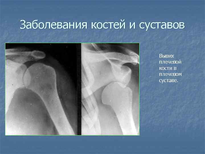 Заболевания костей и суставов Вывих плечевой кости в плечевом суставе. 