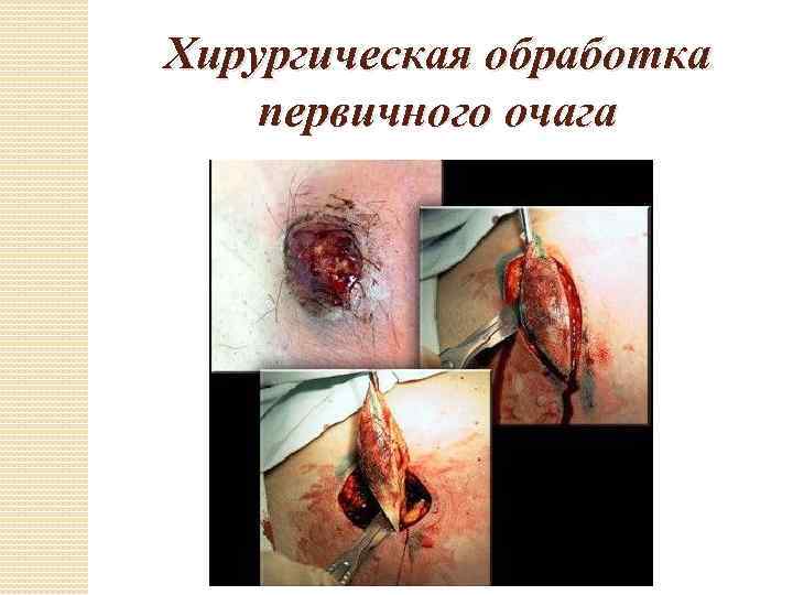 Хирургическая обработка первичного очага 