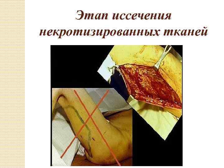 Этап иссечения некротизированных тканей 