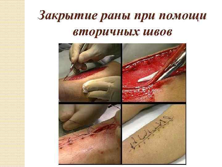 Закрытие раны при помощи вторичных швов 