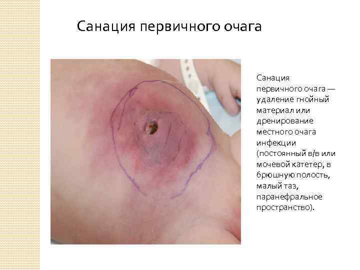 Санация первичного очага — удаление гнойный материал или дренирование местного очага инфекции (постоянный в/в