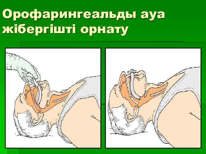 Орофарингеальды ауа жібергішті орнату 