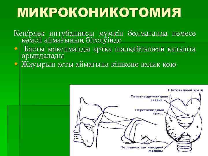 МИКРОКОНИКОТОМИЯ Кеңірдек интубациясы мүмкін болмағанда немесе көмей аймағының бітелуінде w Басты максималды артқа шалқайтылған