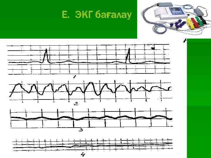 E. ЭКГ бағалау 