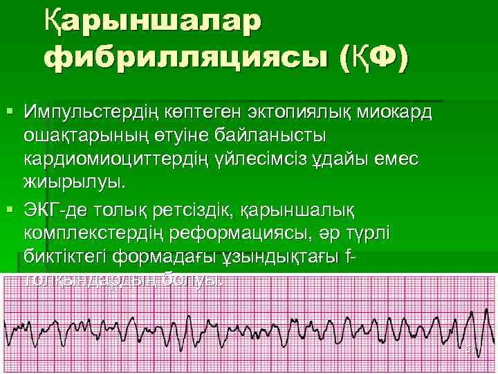 Қарыншалар фибрилляциясы (ҚФ) § Импульстердің көптеген эктопиялық миокард ошақтарының өтуіне байланысты кардиомиоциттердің үйлесімсіз ұдайы