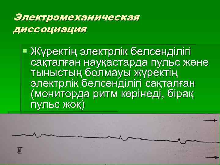 Электромеханическая диссоциация § Жүректің электрлік белсенділігі сақталған науқастарда пульс және тыныстың болмауы жүректің электрлік