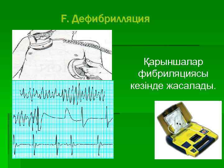 F. Дефибрилляция Қарыншалар фибриляциясы кезінде жасалады. 