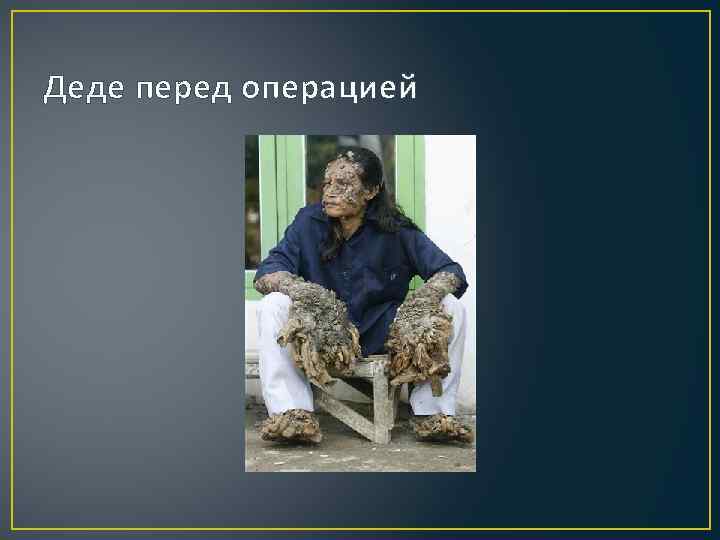 Деде перед операцией 