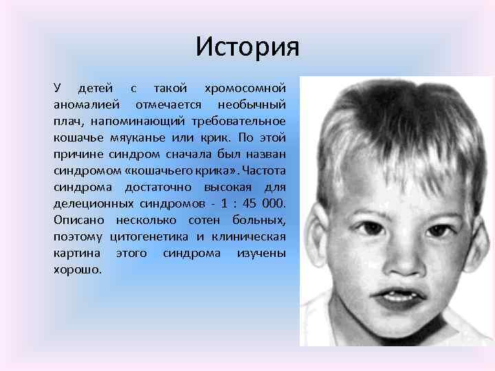 История У детей с такой хромосомной аномалией отмечается необычный плач, напоминающий требовательное кошачье мяуканье