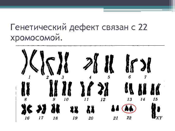 Генетический дефект связан с 22 хромосомой. 