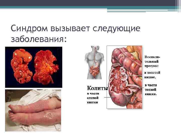Синдром вызывает следующие заболевания: 