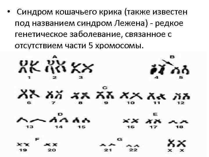  • Синдром кошачьего крика (также известен под названием синдром Лежена) - редкое генетическое