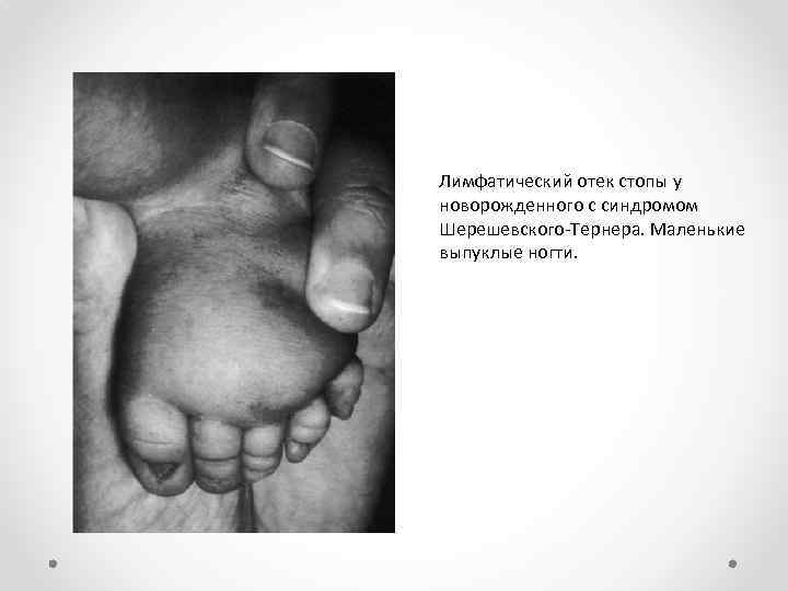 Лимфатический отек стопы у новорожденного с синдромом Шерешевского-Тернера. Маленькие выпуклые ногти. 