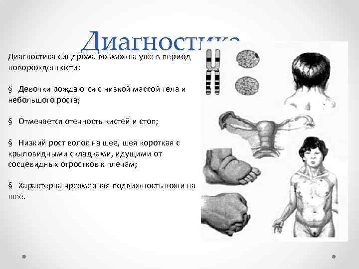 Диагностика синдрома возможна уже в период новорожденности: § Девочки рождаются с низкой массой тела