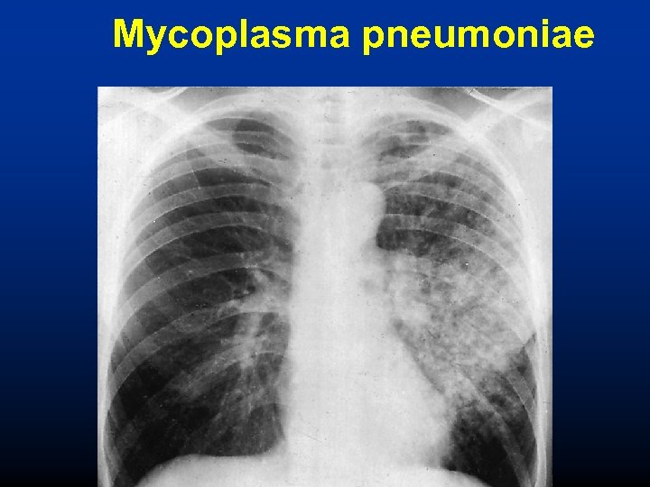 Mycoplasma pneumoniae 