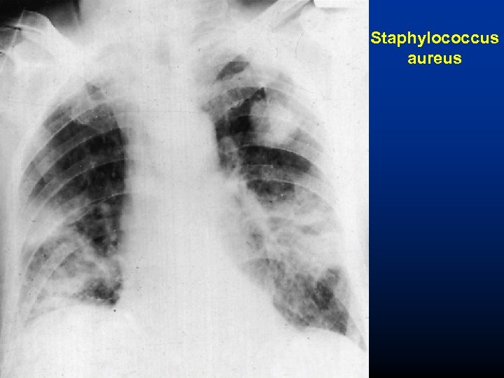 Staphylococcus aureus 