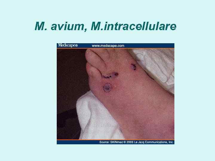 M. avium, M. intracellulare 