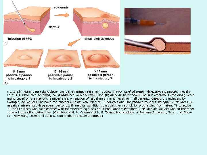 Fig. 2 Skin testing for tuberculosis, using the Mantoux test. (a) Tuberculin PPD (purified