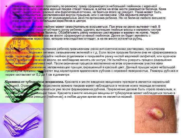 n Развитие ранки может протекать по-разному: сразу сформируется небольшой гнойничок с корочкой посередине, или