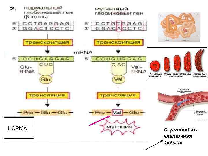 НОРМА Серповидноклеточная анемия 