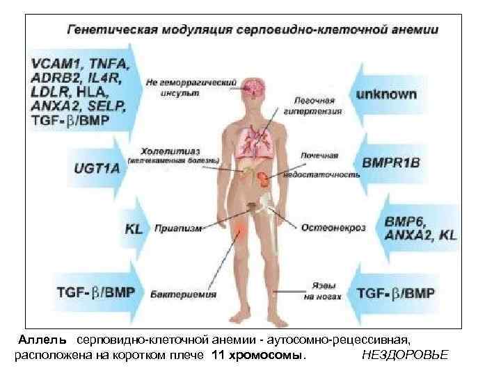 Аллель серповидно-клеточной анемии - аутосомно-рецессивная, расположена на коротком плече 11 хромосомы. НЕЗДОРОВЬЕ 