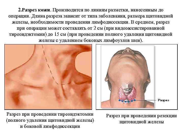 2. Разрез кожи. Производится по линиям разметки, нанесенным до операции. Длина разреза зависит от