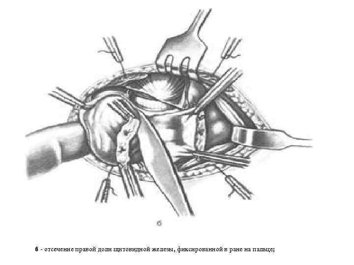 б - отсечение правой доли щитовидной железы, фиксированной в ране на пальце; 