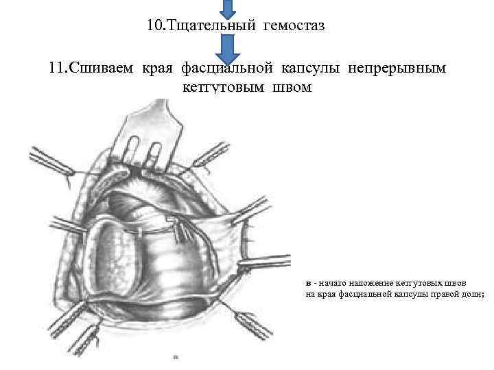 10. Тщательный гемостаз 11. Сшиваем края фасциальной капсулы непрерывным кетгутовым швом в - начато