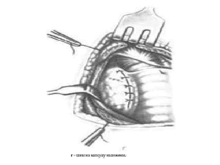 г - швы на капсулу наложены. 