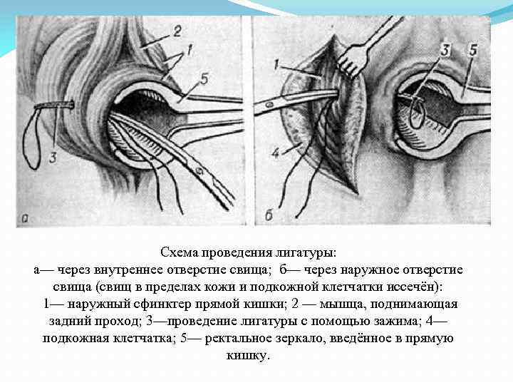 Схема проведения лигатуры: а— через внутреннее отверстие свища; б— через наружное отверстие свища (свищ