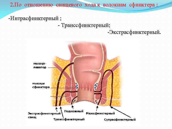 2. По отношению свищевого хода к волокнам сфинктера : -Интрасфинктерный ; - Транссфинктерный; -Экстрасфинктерный.