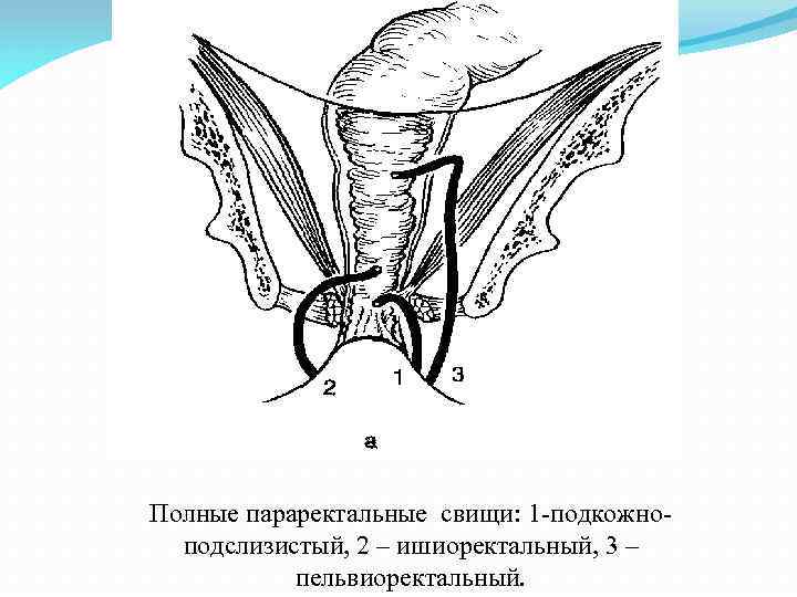 Полные параректальные свищи: 1 -подкожноподслизистый, 2 – ишиоректальный, 3 – пельвиоректальный. 