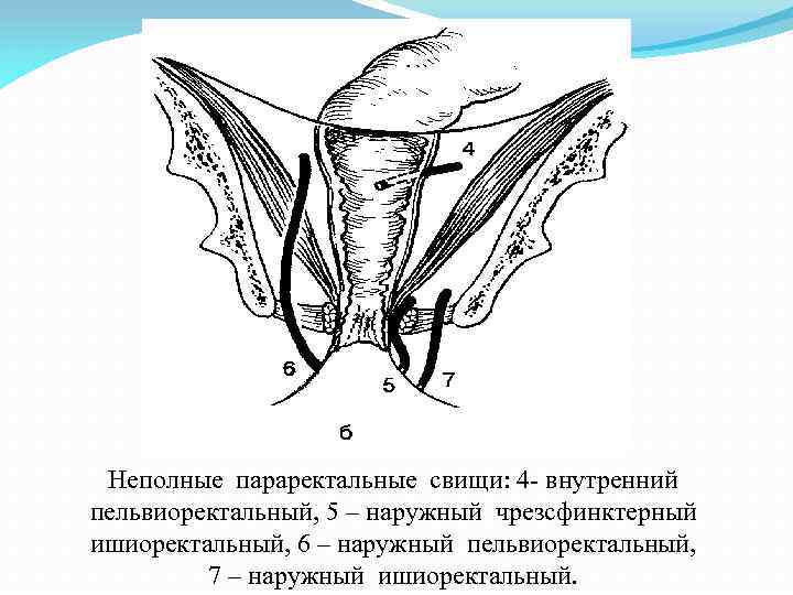 Неполные параректальные свищи: 4 - внутренний пельвиоректальный, 5 – наружный чрезсфинктерный ишиоректальный, 6 –