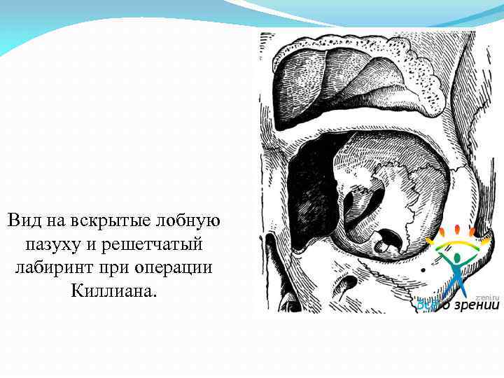 Вид на вскрытые лобную пазуху и решетчатый лабиринт при операции Киллиана. 