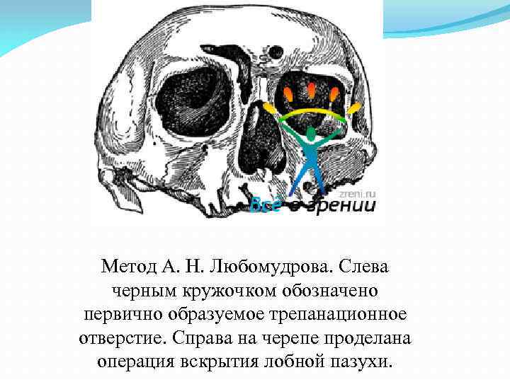 Метод А. Н. Любомудрова. Слева черным кружочком обозначено первично образуемое трепанационное отверстие. Справа на