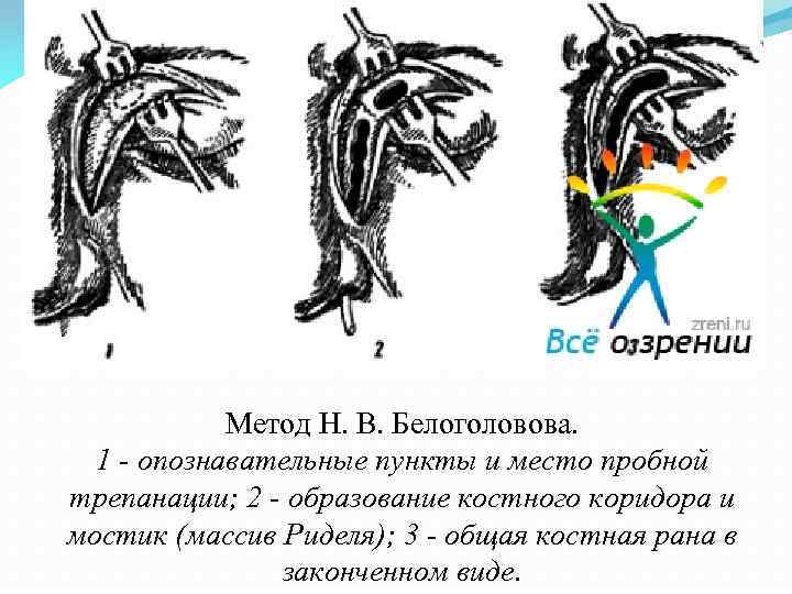 Метод Н. В. Белоголовова. 1 - опознавательные пункты и место пробной трепанации; 2 -
