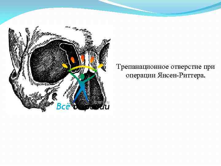 Трепанационное отверстие при операции Янсен Риттера. 