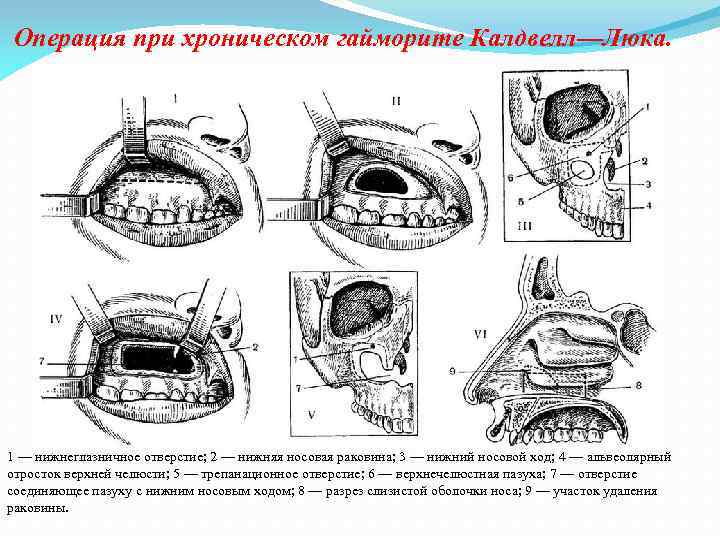 Операция при хроническом гайморите Калдвелл—Люка. 1 — нижнеглазничное отверстие; 2 — нижняя носовая раковина;