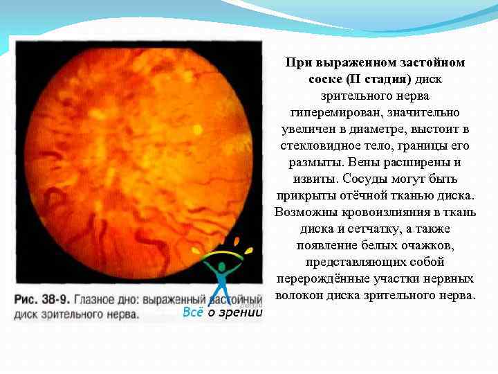 При выраженном застойном соске (II стадия) диск зрительного нерва гиперемирован, значительно увеличен в диаметре,