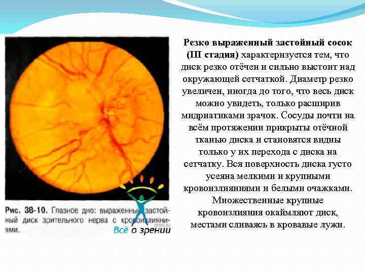 Резко выраженный застойный сосок (III стадия) характеризуется тем, что диск резко отёчен и сильно