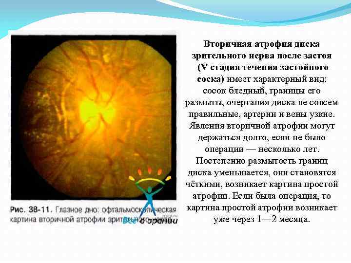 Вторичная атрофия диска зрительного нерва после застоя (V стадия течения застойного соска) имеет характерный