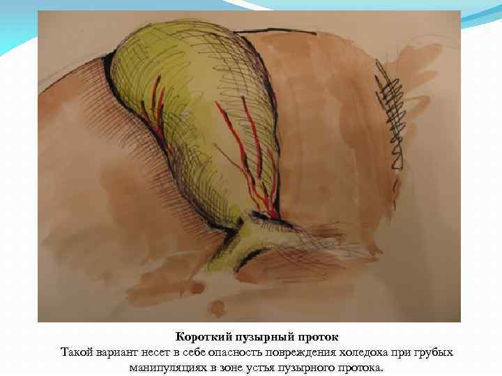 Культя пузырного протока. Варианты анатомии треугольника Кало. Мочепузырный треугольник анатомия. Культя пузырного протока после холецистэктомии.