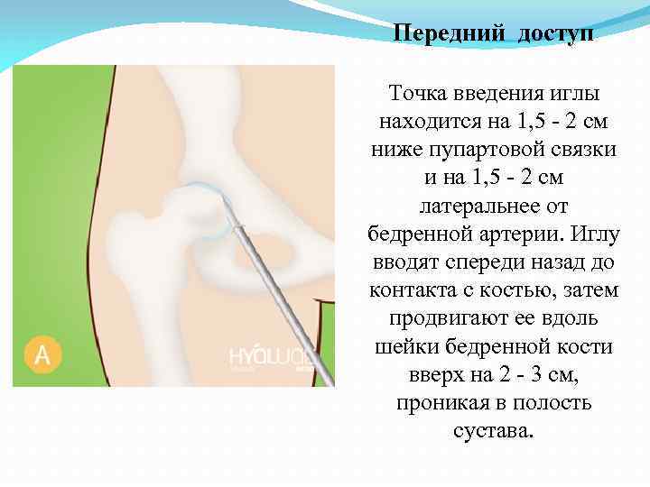 Передний доступ Точка введения иглы находится на 1, 5 - 2 см ниже пупартовой