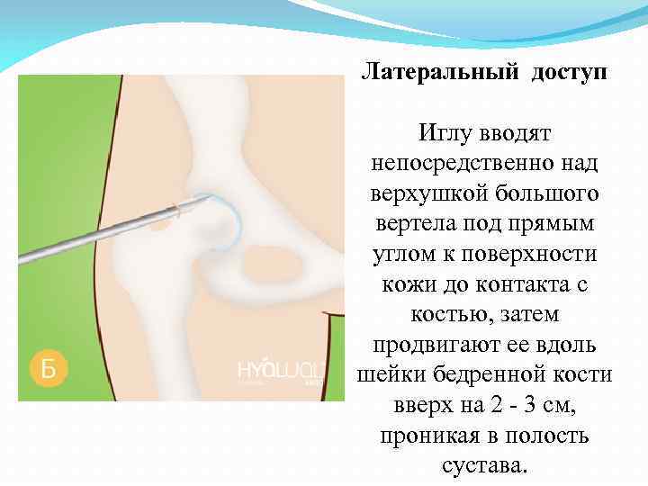 Латеральный доступ Иглу вводят непосредственно над верхушкой большого вертела под прямым углом к поверхности