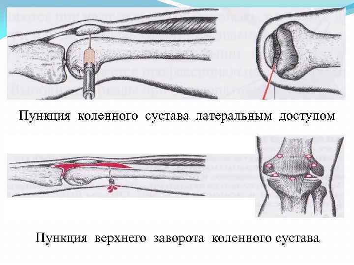 Пункция коленного сустава латеральным доступом Пункция верхнего заворота коленного сустава 