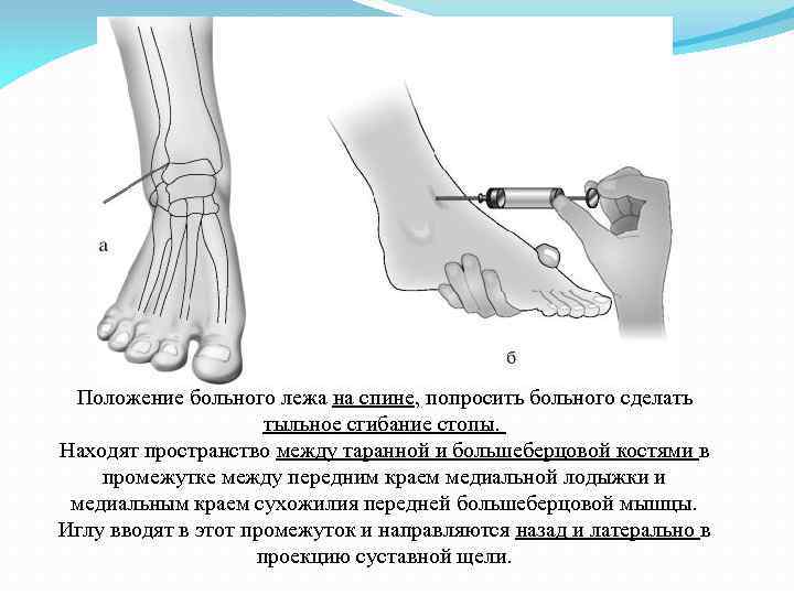 Положение больного лежа на спине, попросить больного сделать тыльное сгибание стопы. Находят пространство между