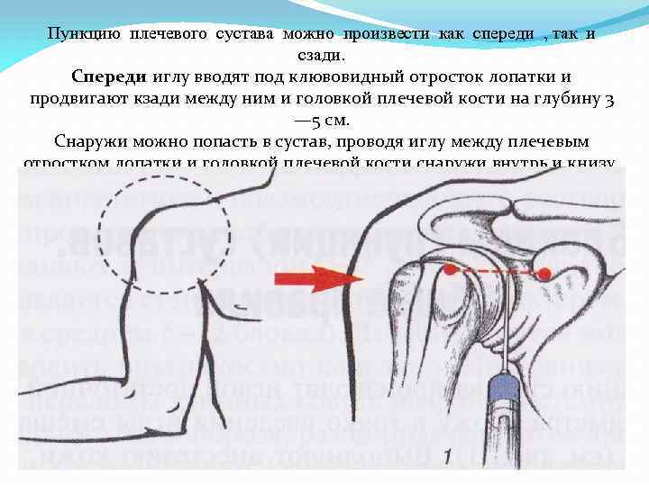 Пункцию плечевого сустава можно произвести как спереди , так и сзади. Спереди иглу вводят