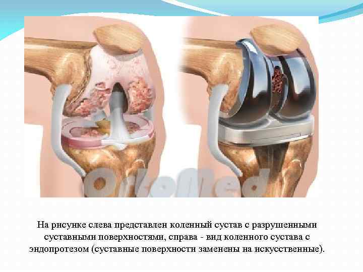 Суставные поверхности конгруэнтны