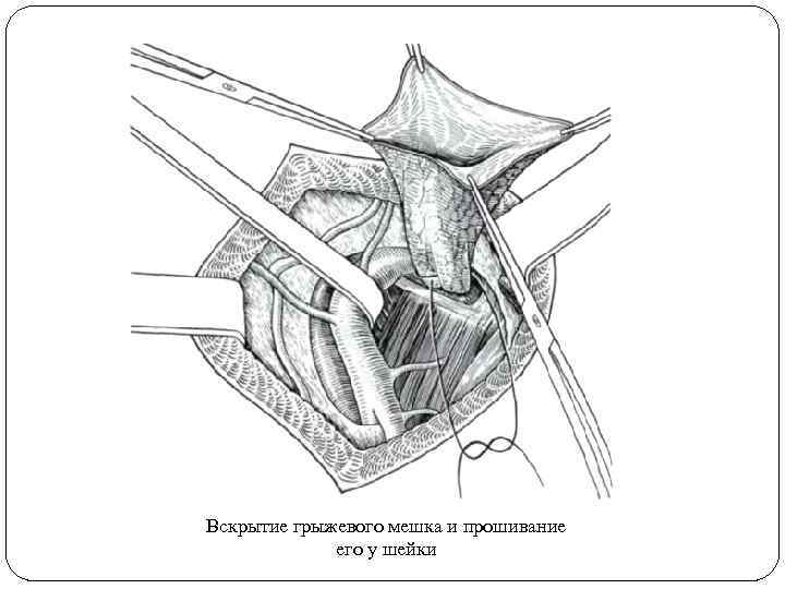 Пластика бедренного канала