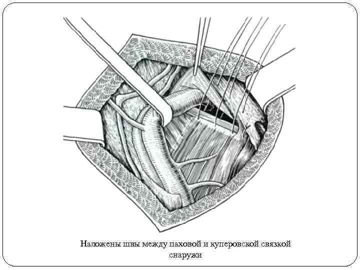 Наложены швы между паховой и куперовской связкой снаружи 